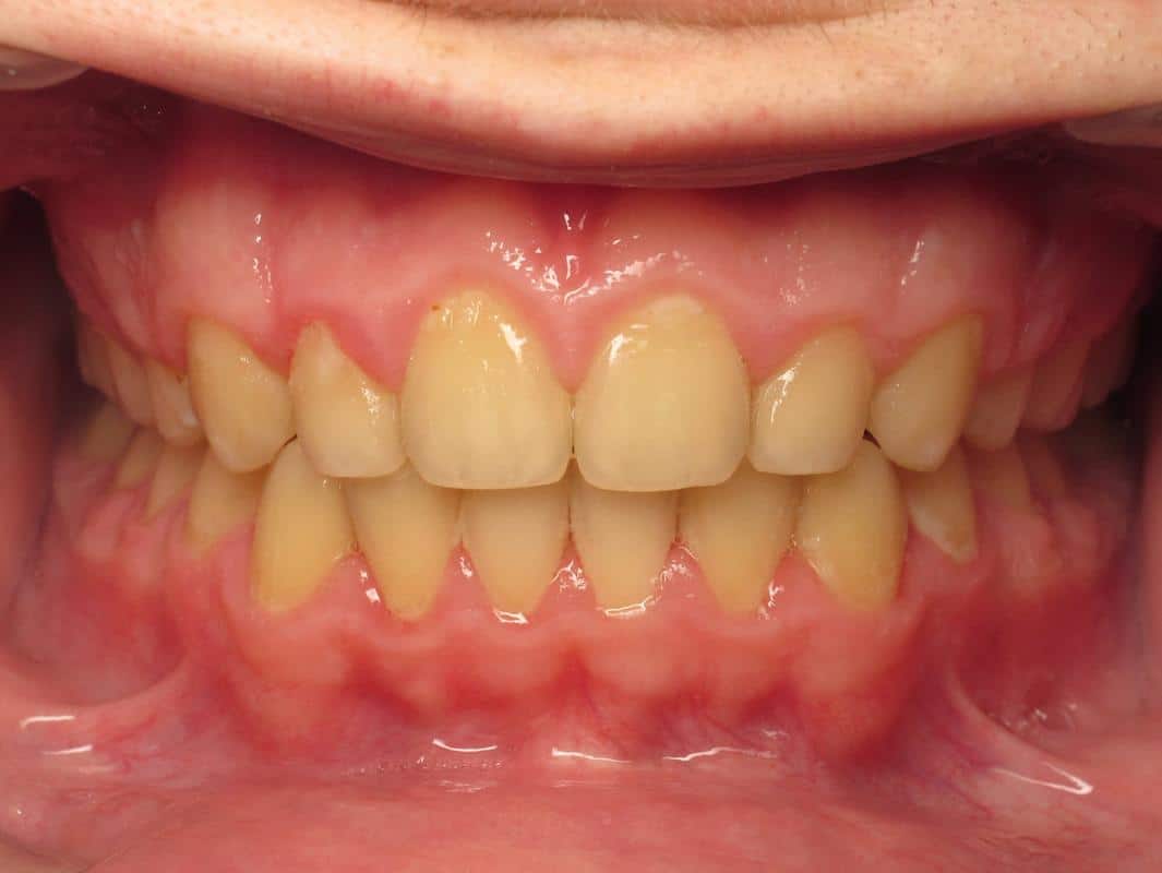 Eberle-orthodontics-after-1 Eberle orthodontics after 1