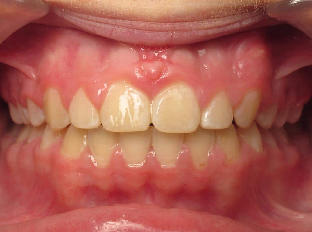 Eberle-orthodontics-after-3 Eberle orthodontics after 3