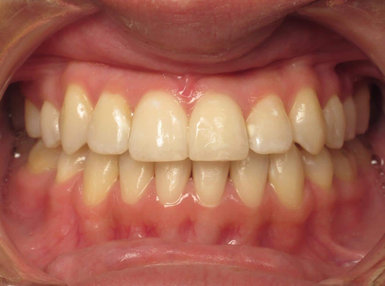 Eberle-orthodontics-after-4 Eberle orthodontics after 4