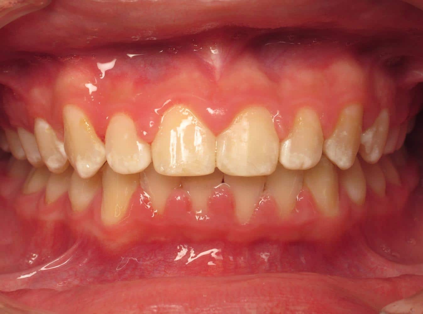 Eberle-orthodontics-after-5 Eberle orthodontics after 5