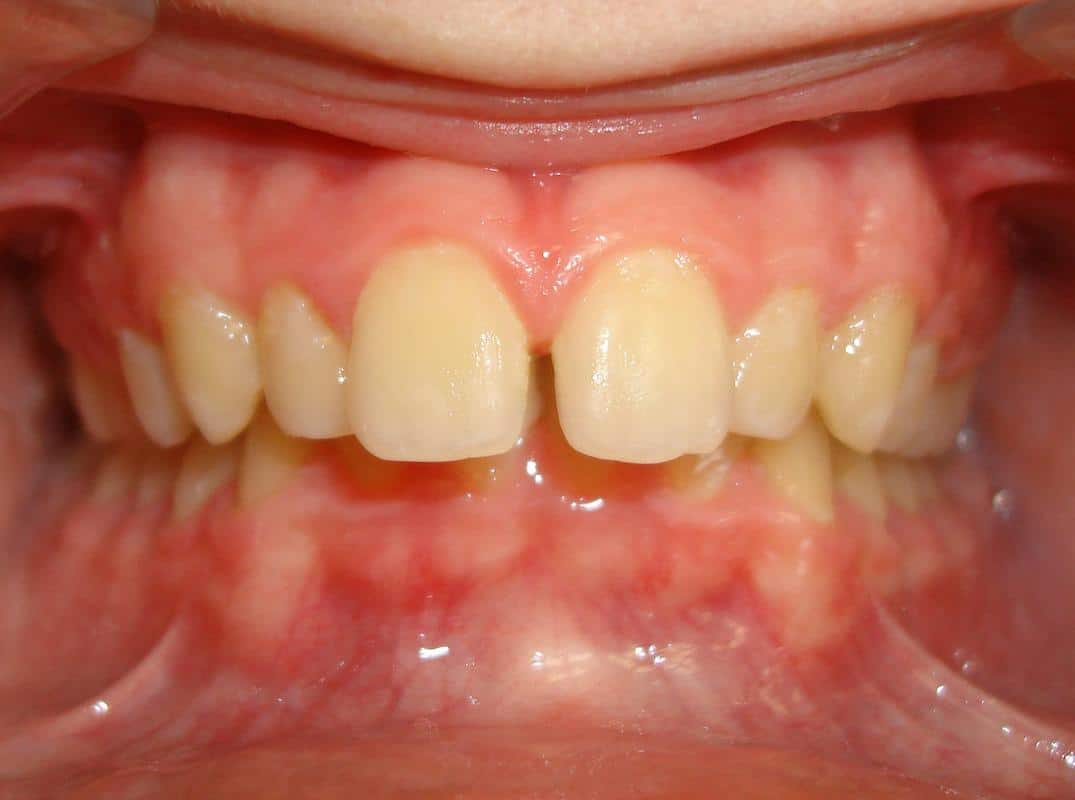 Eberle-orthodontics-before-1 Eberle orthodontics before 1