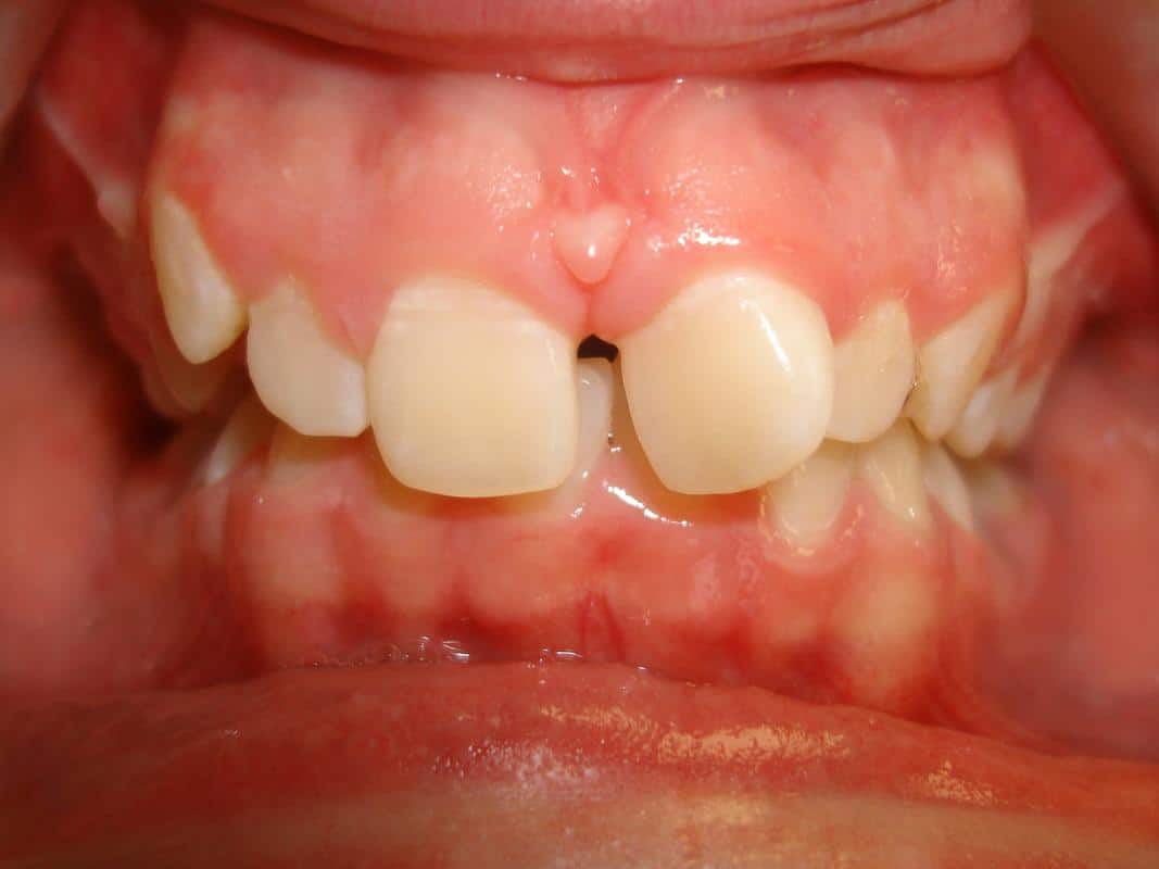 Eberle-orthodontics-before-3 Eberle orthodontics before 3