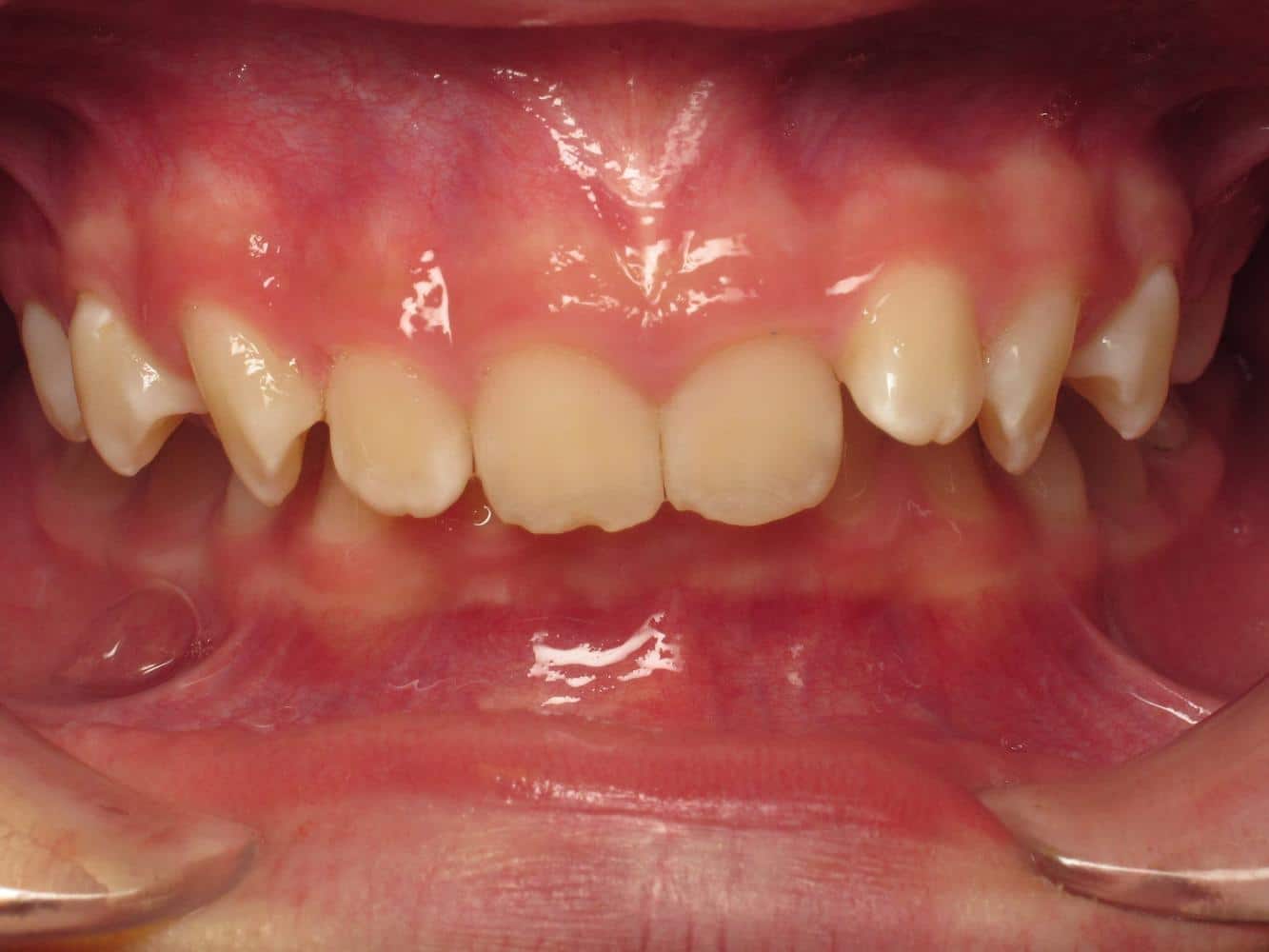 Eberle-orthodontics-before-5 Eberle orthodontics before 5