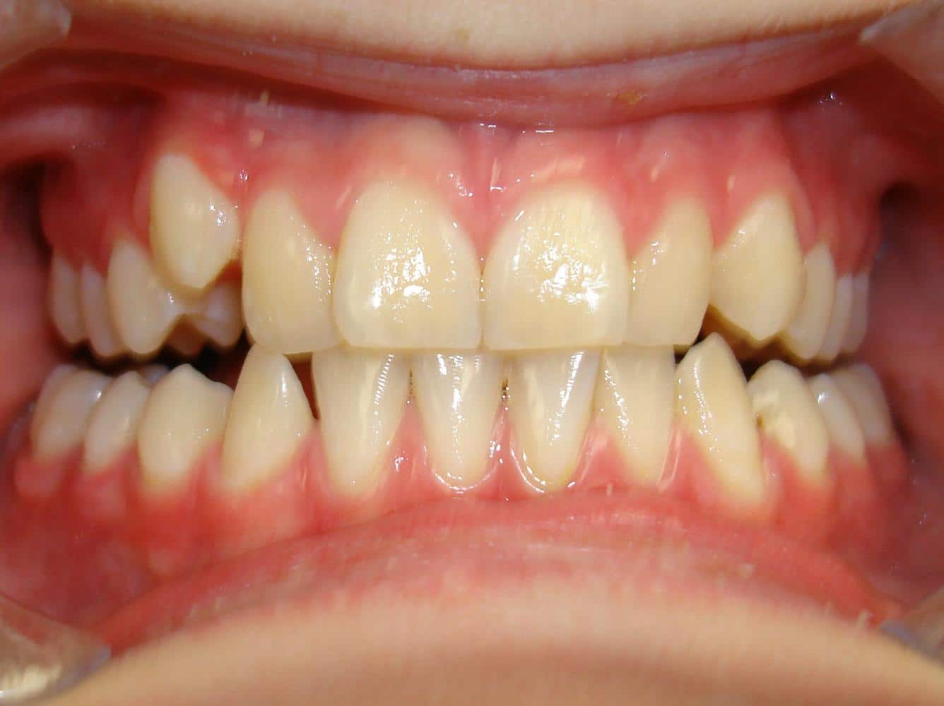 Eberle-orthodontics-before-6 Eberle orthodontics before 6