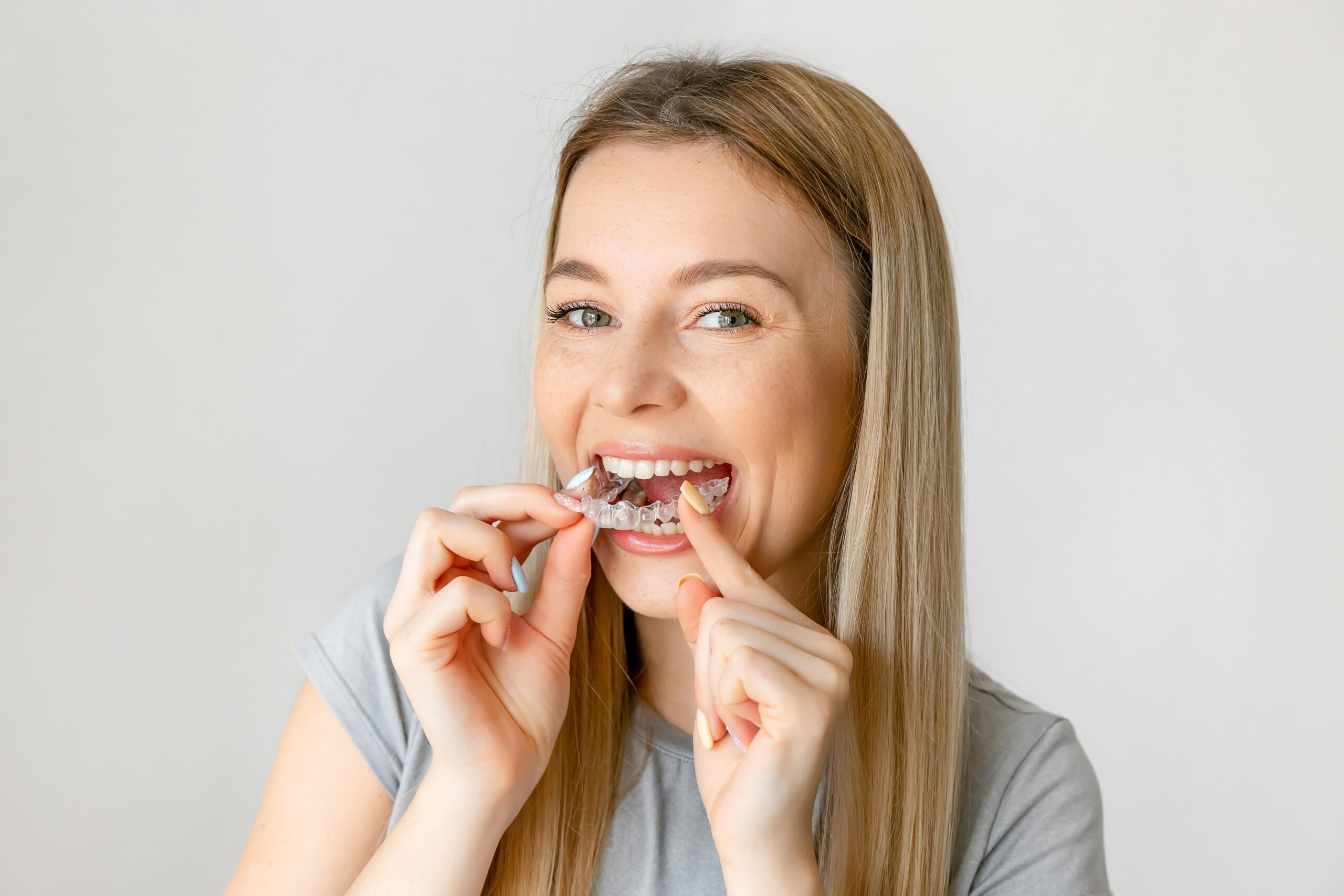 Orthodontics-for-adults Adult orthodontic treatment