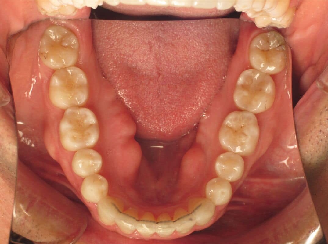 Eberle-ortho-patient-8-after Close-up of a person's mouth