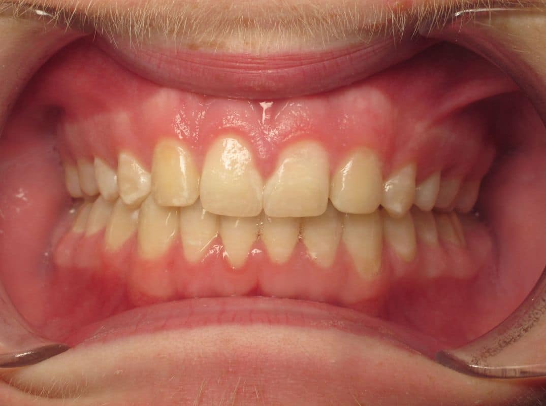 Patient-1-after Close-up of a person's mouth