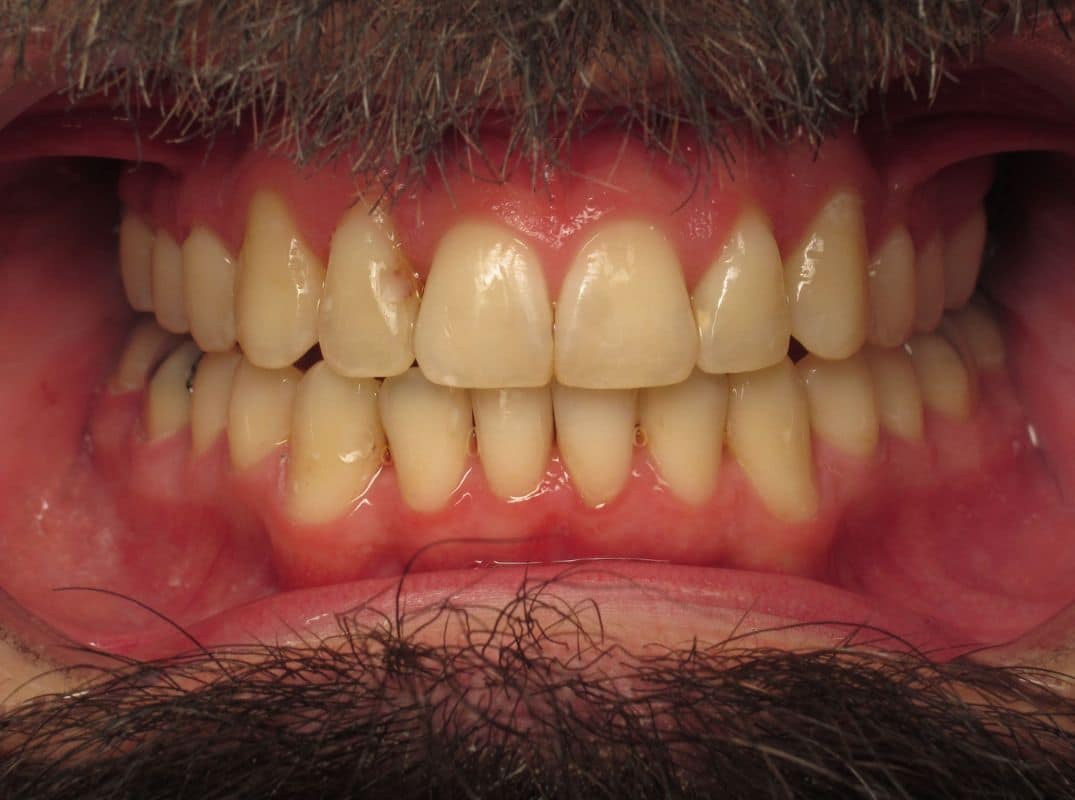 Patient-11-after Patient 11 after