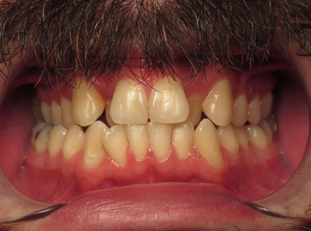 Patient-11-before Patient 11 before