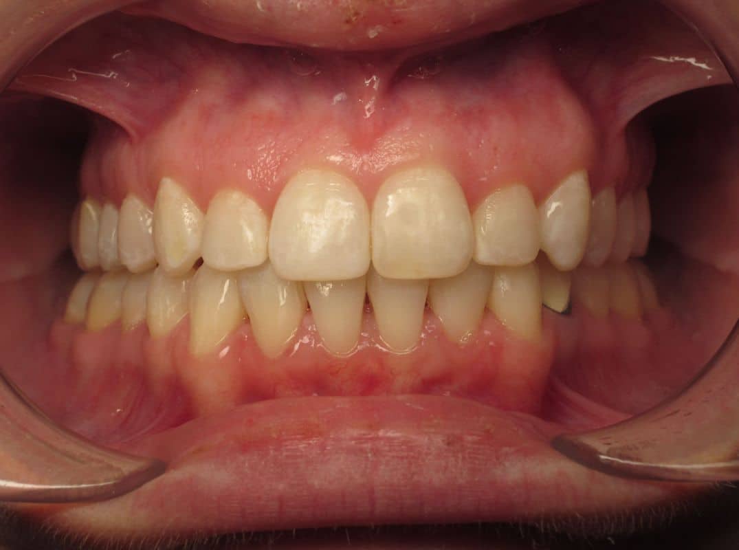 Patient-12-after Patient 12 after