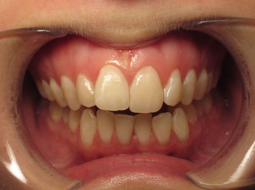 Patient-15-before Patient 15 before