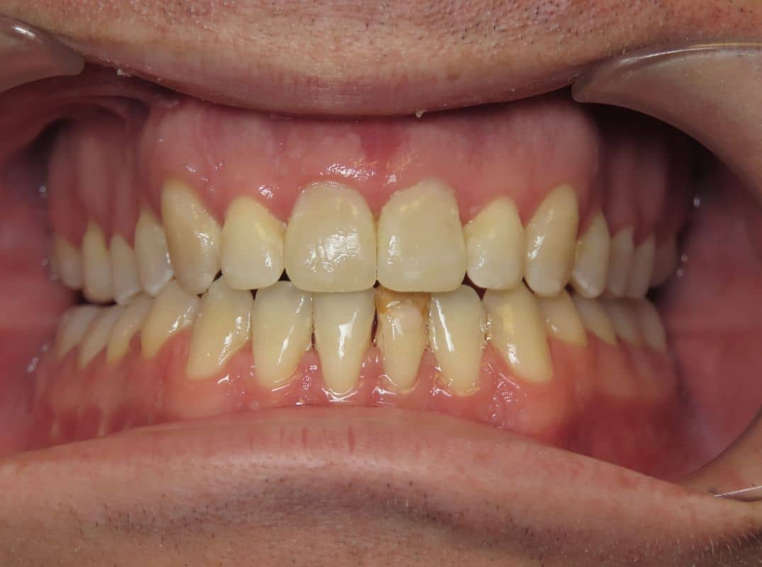 Patient-2-after Close up of teeth and gums