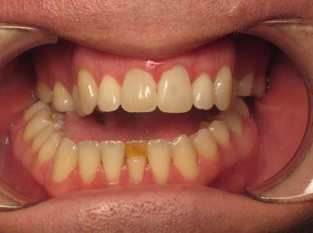 Patient-2-before Close up of a person's mouth and teeth