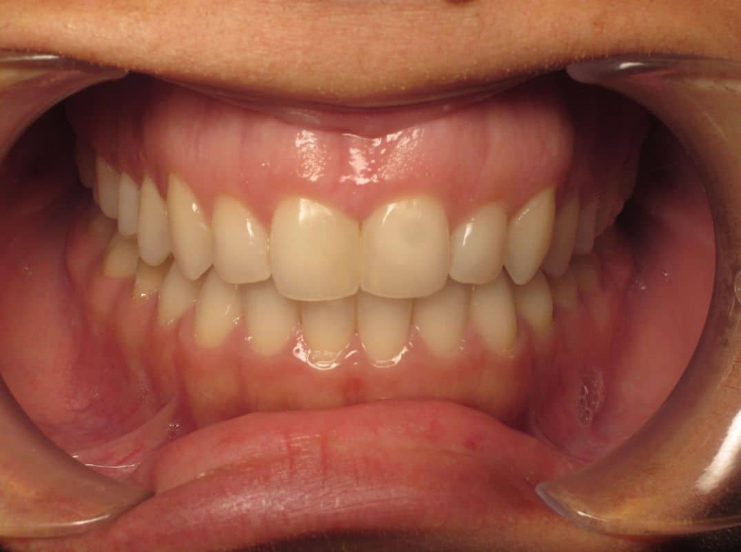 Patient-3-after Patient 3 after