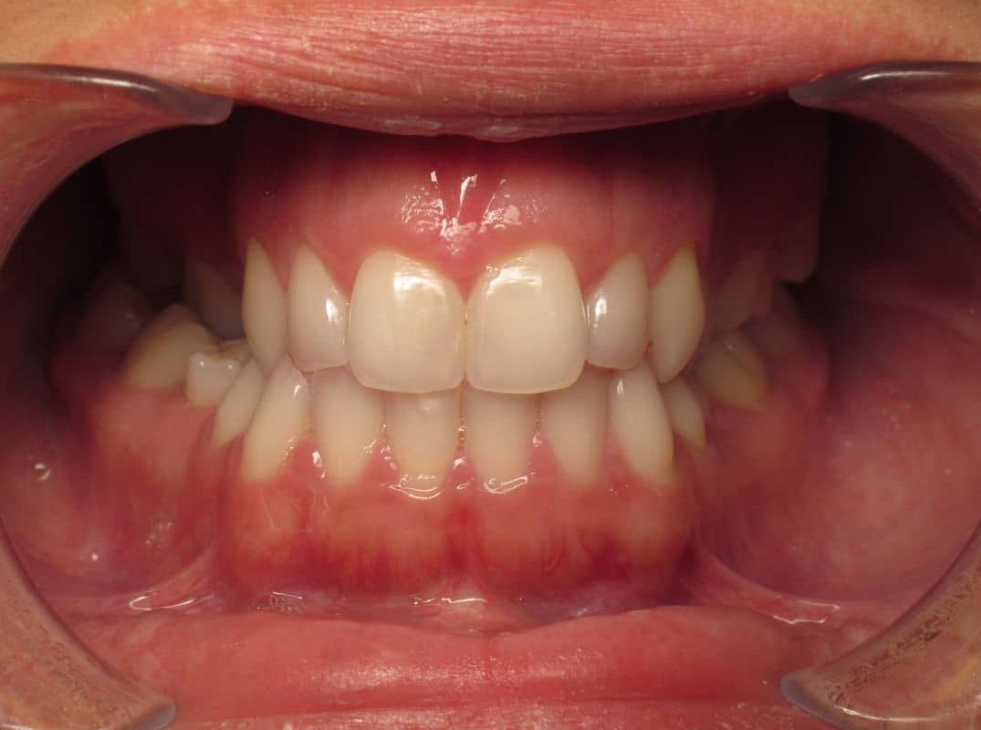 Patient-3-before Close up of a person's mouth