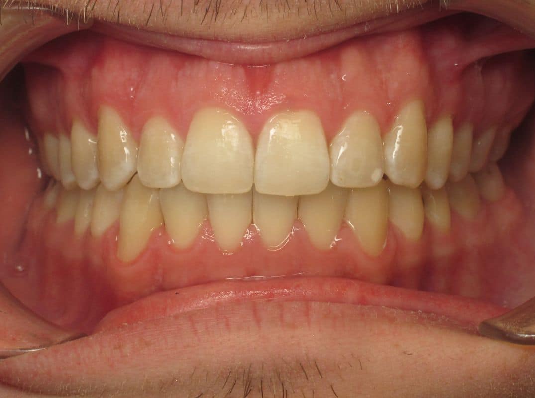 Patient-4-after Patient 4 after