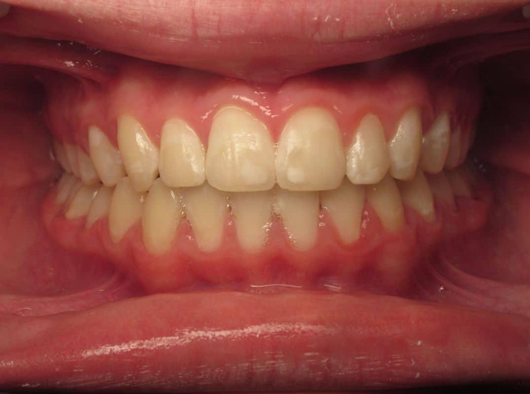 Patient-6-after Patient 6 after