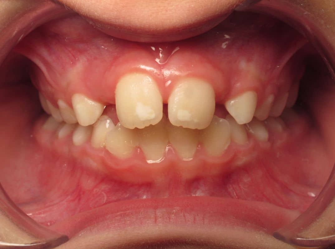 Patient-6-before Patient 6 before