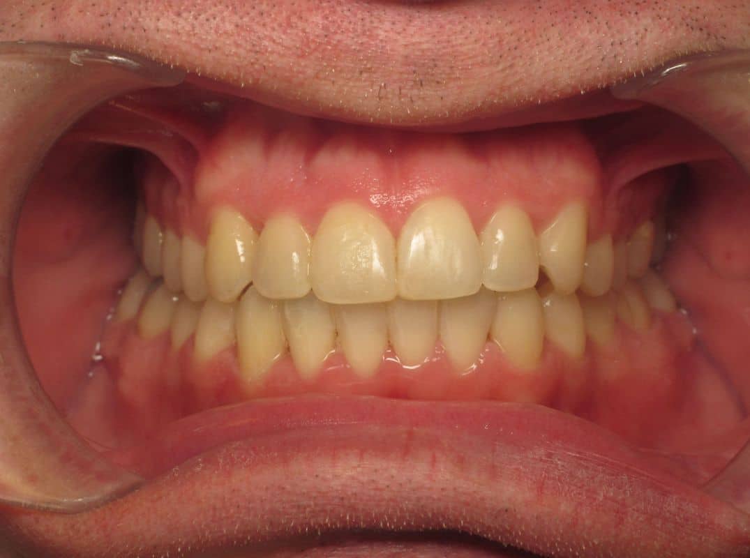 Patient-9-after Patient 9 after