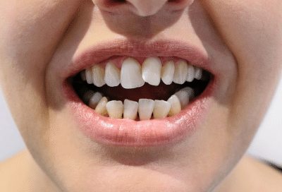 The connection between crooked teeth and gum disease 11 Closeup of crooked teeth, representing the connection between crooked teeth and gum disease