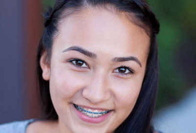 What to bring when traveling with braces 5 Teen smiling with braces, highlighting healthy orthodontic care and what to bring when traveling with braces for maintaining oral hygiene on the go.